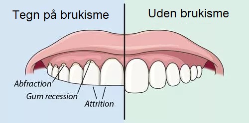 grinding teeth in sleep